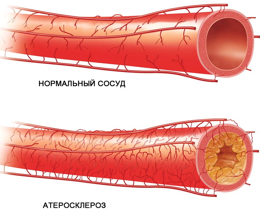 ateroskleroz-sosudov (1)