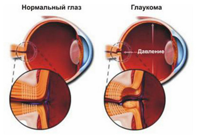 glaukoma-5501