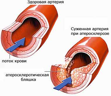 здоровая артерия и артерия с атеросклерозом