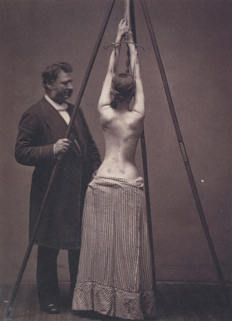 Лечение сколиоза, 1870–е, США