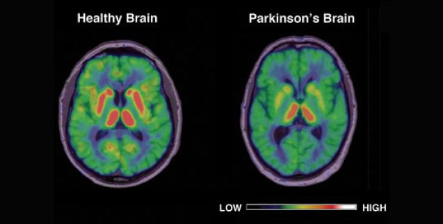 parkinson-brain-image